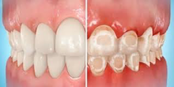 Will Orthodontic Treatment Cause White Marks on my Teeth